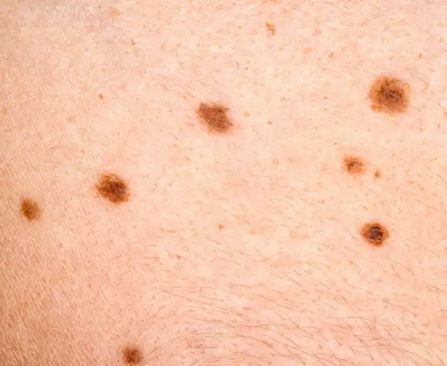 What causes moles and should you remove them?